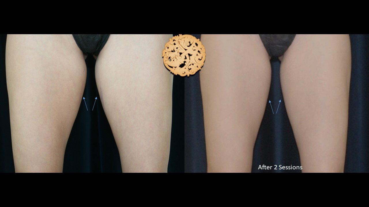 Thigh Coolsculpting Before & After