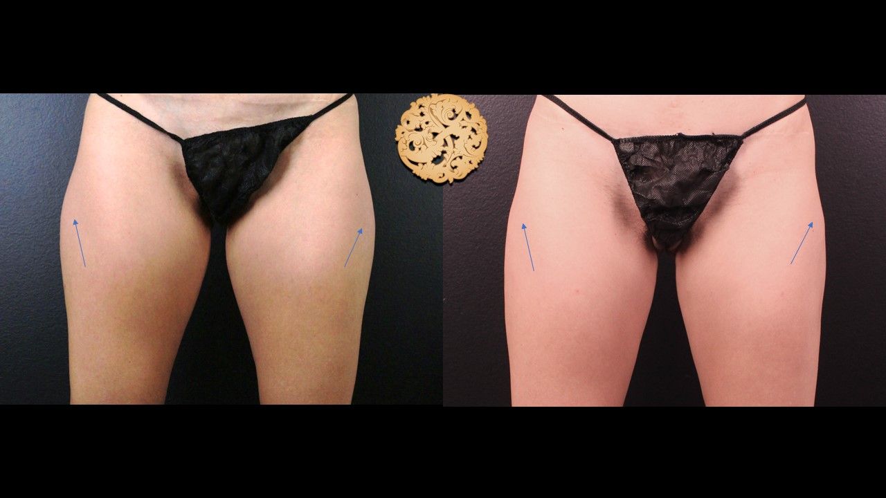 Thigh Coolsculpting Before & After