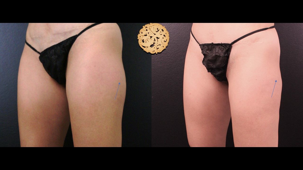 Thigh Coolsculpting Before & After