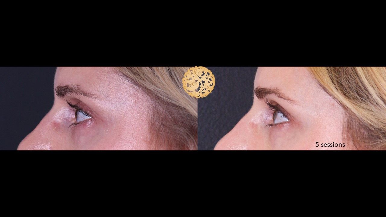 Pelleve Before & After