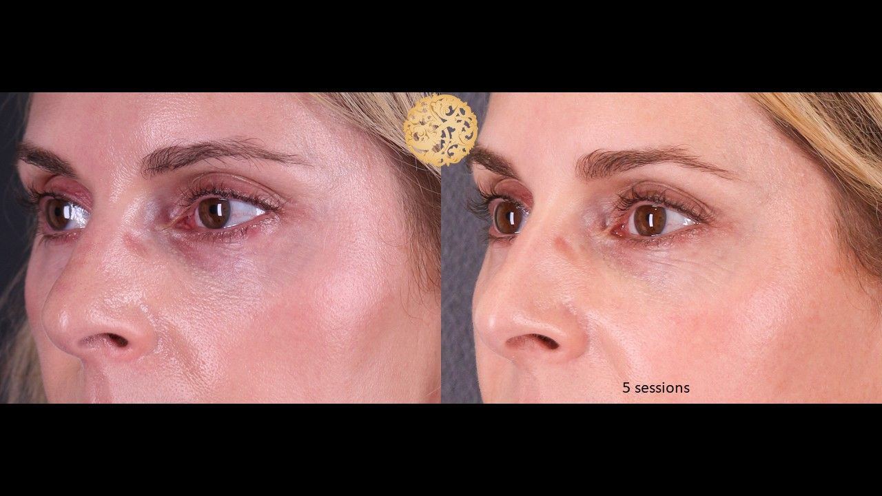 Pelleve Before & After