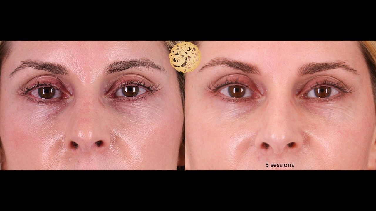 Pelleve Before & After