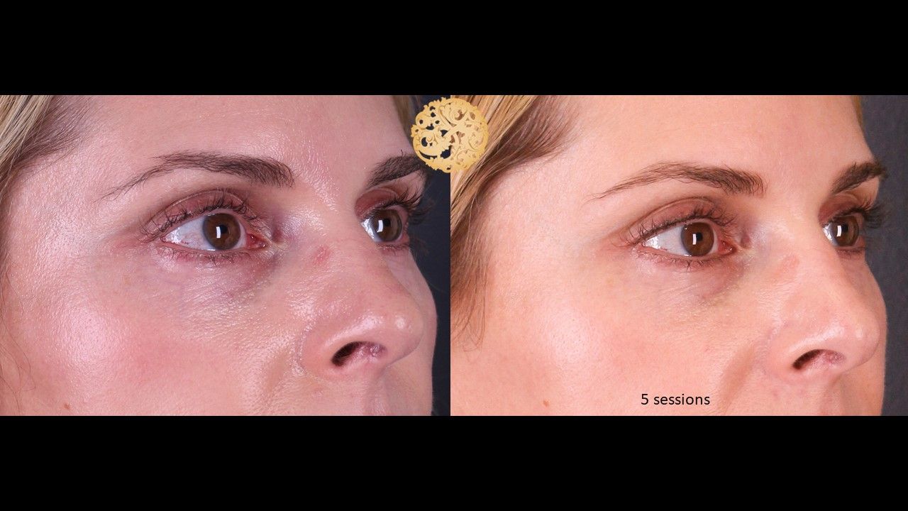 Pelleve Before & After