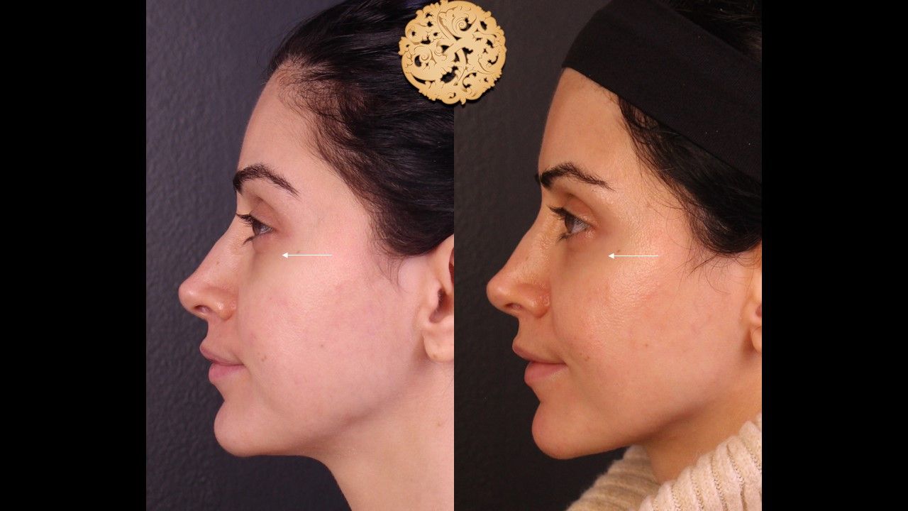 Pelleve Before & After