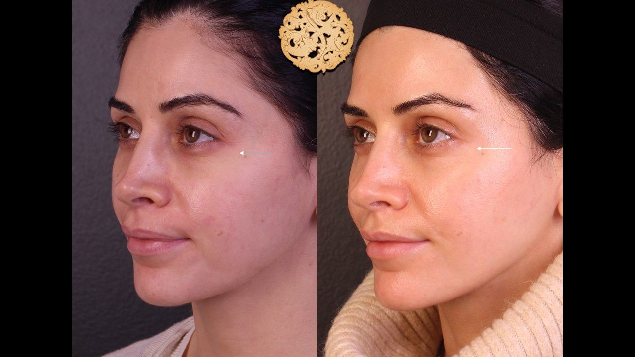 Pelleve Before & After