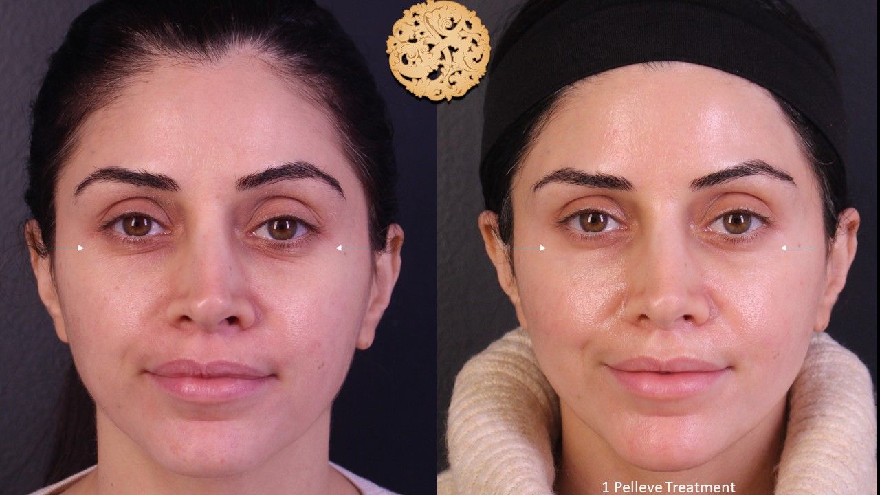 Pelleve Before & After