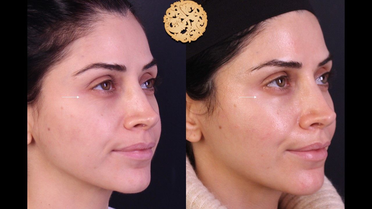 Pelleve Before & After