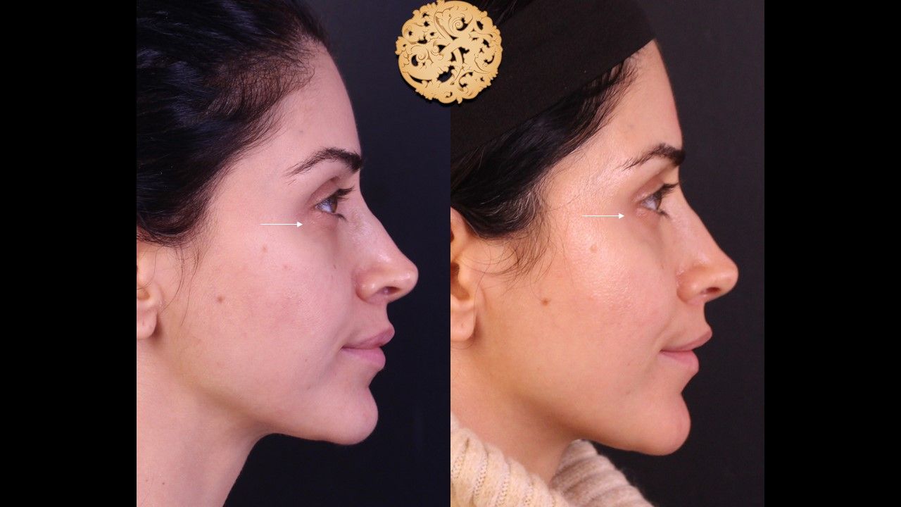 Pelleve Before & After