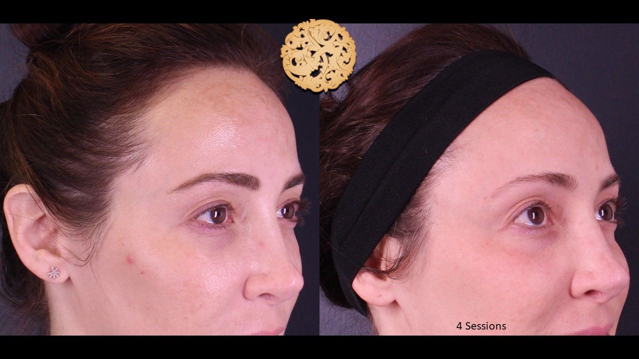 Pelleve Before & After