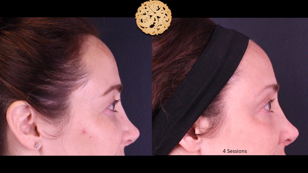 Pelleve Before & After