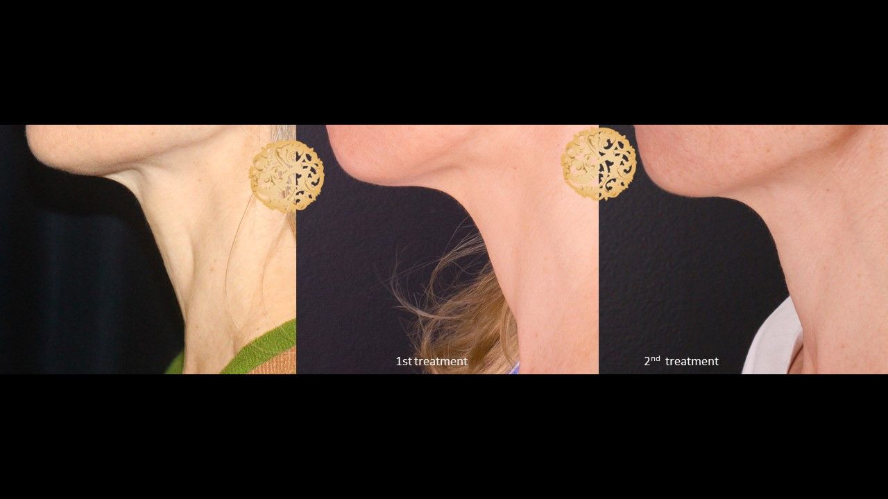 Pelleve Before & After