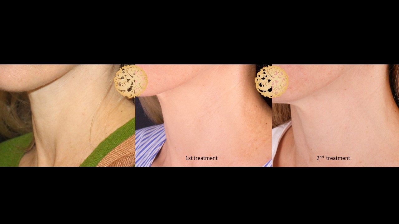 Pelleve Before & After