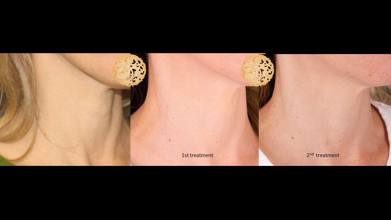 Pelleve Before & After