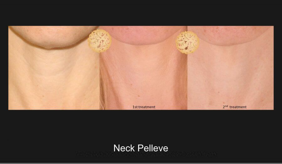 Pelleve Before & After