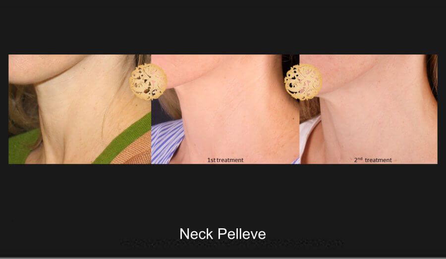 Pelleve Before & After