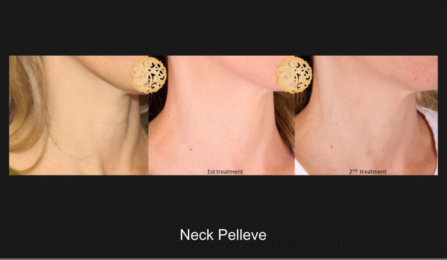 Pelleve Before & After