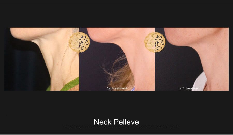 Pelleve Before & After