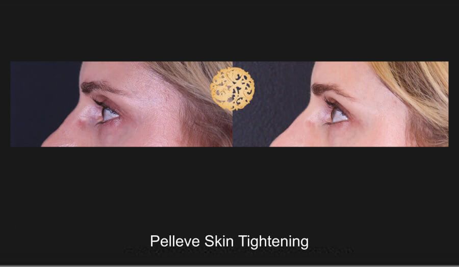 Pelleve Before & After