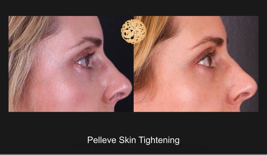 Pelleve Before & After