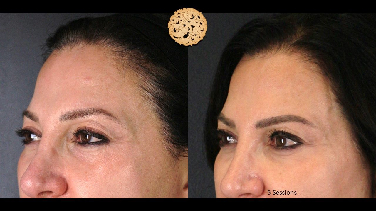 Pelleve Before & After