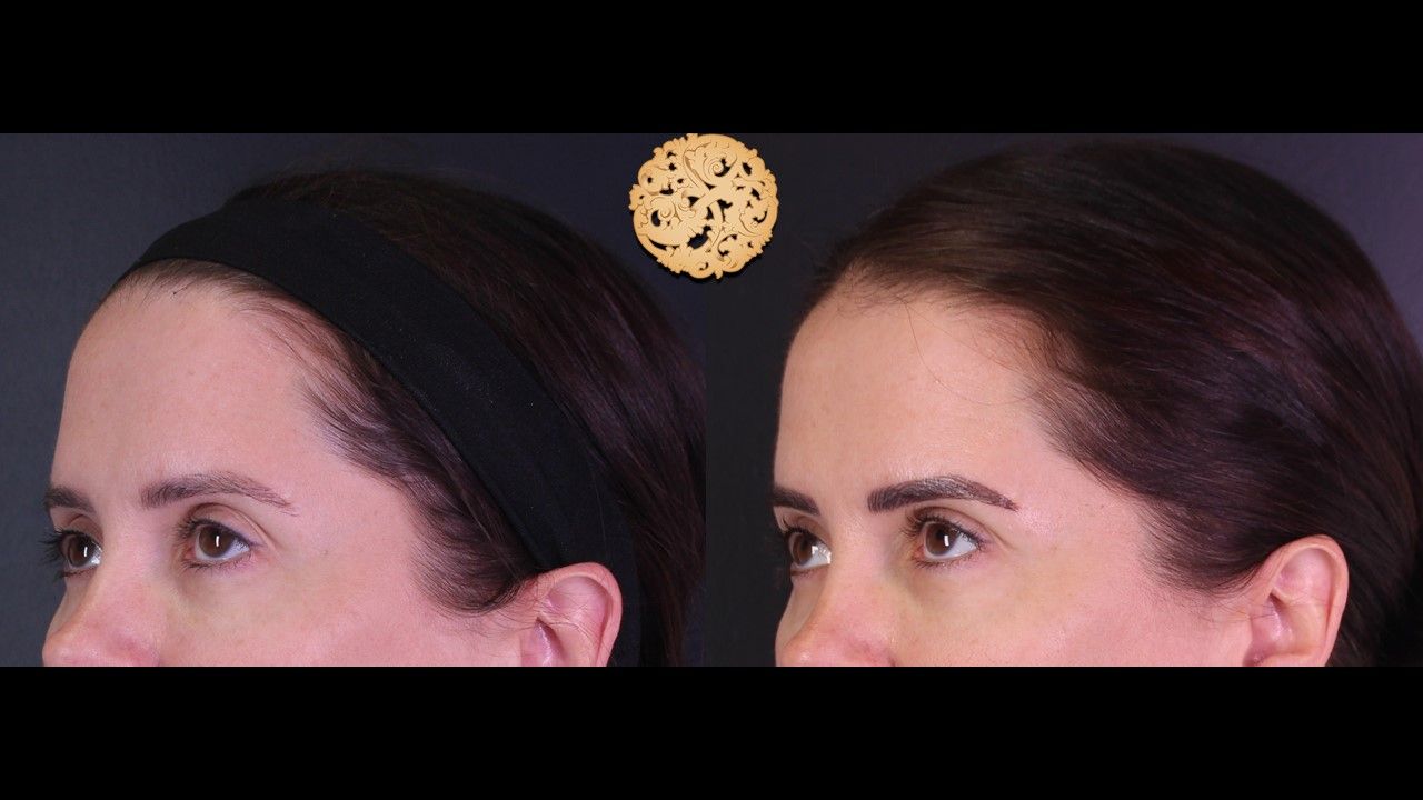 Pelleve Before & After