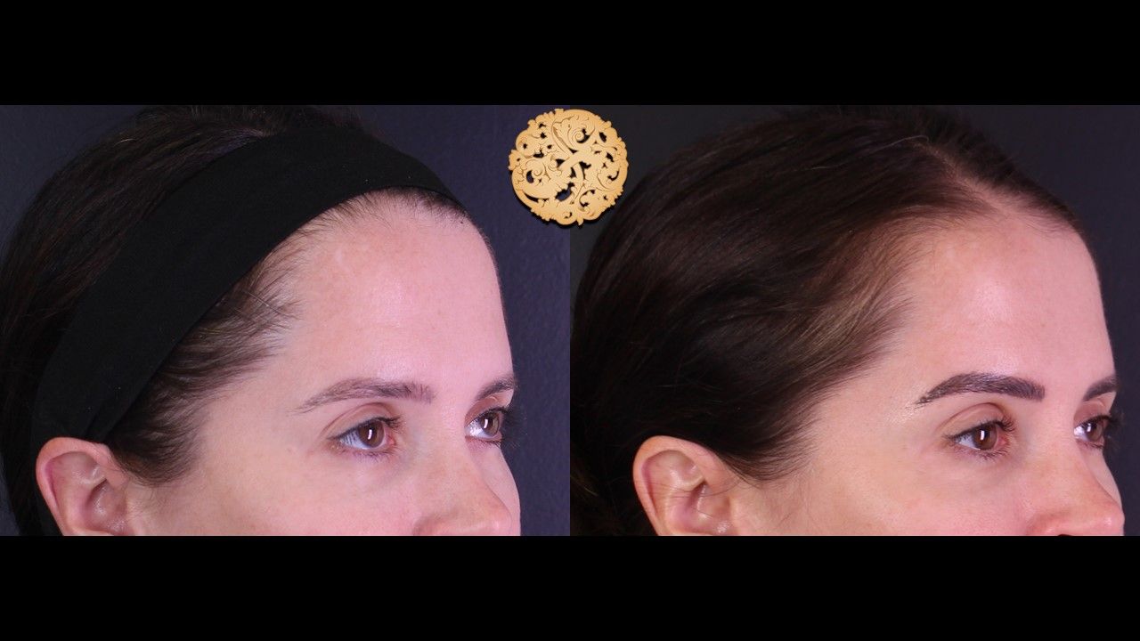 Pelleve Before & After