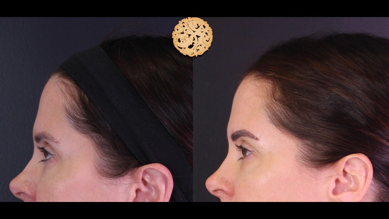 Pelleve Before & After