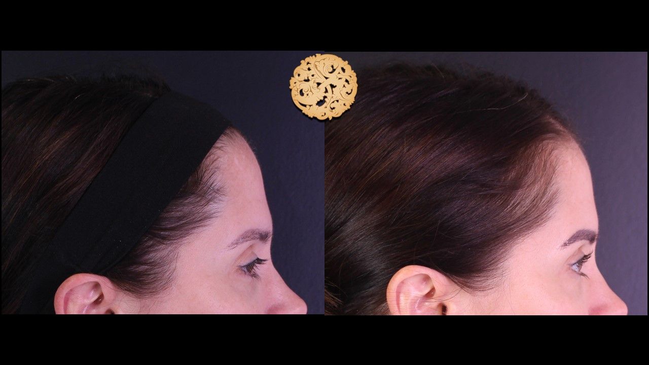 Pelleve Before & After