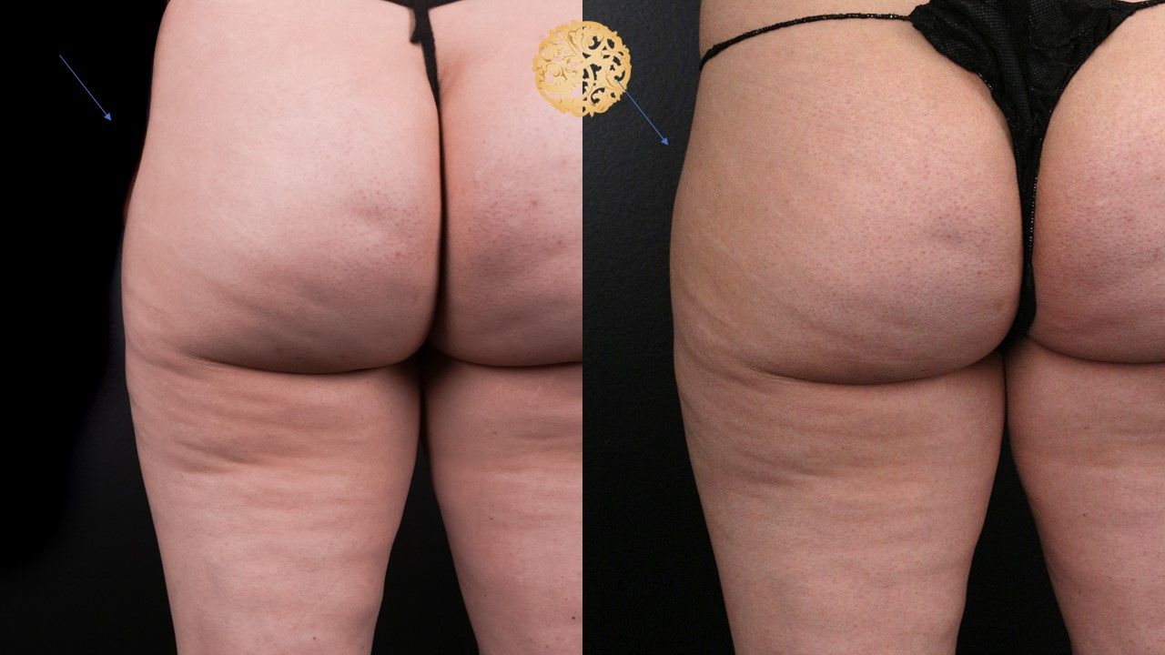 Butt Coolsculpting Before & After