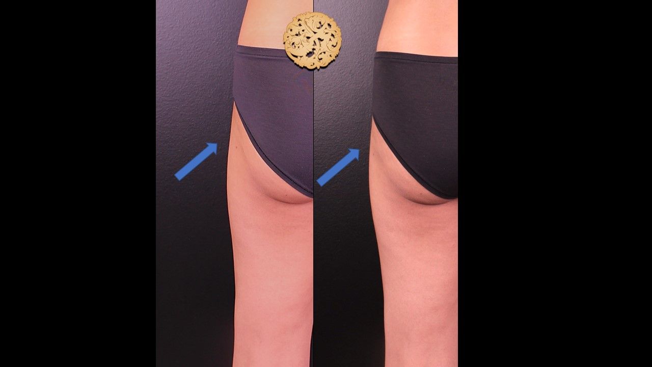 Butt Coolsculpting Before & After