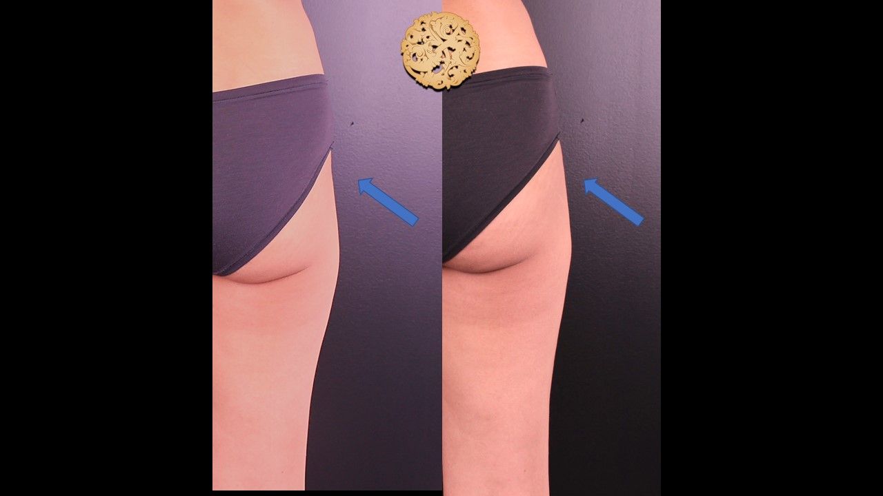 Butt Coolsculpting Before & After