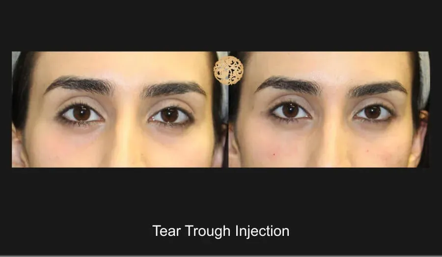 Under Eye Filler Before & After