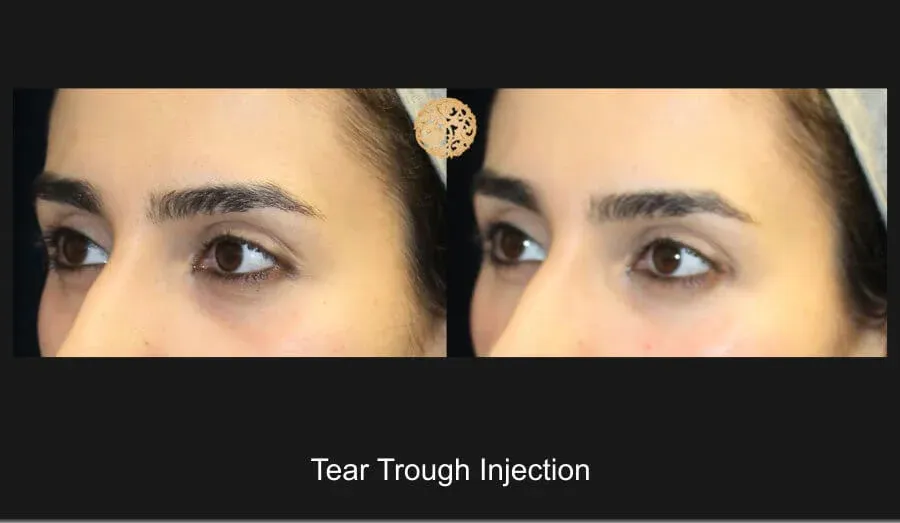 Under Eye Filler Before & After