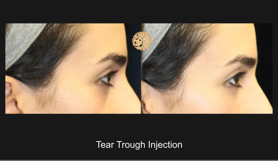 Under Eye Filler Before & After