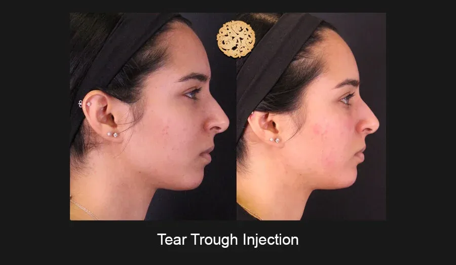 Under Eye Filler Before & After