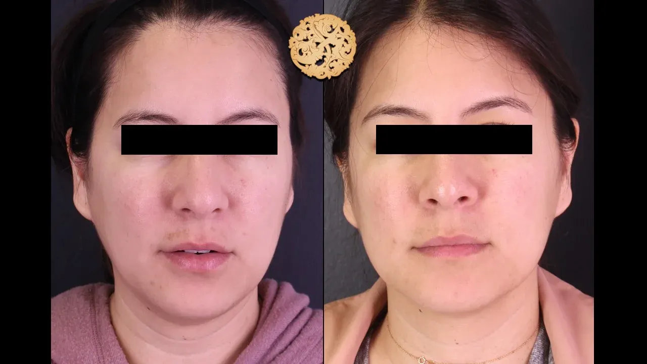 Under Eye Filler Before & After