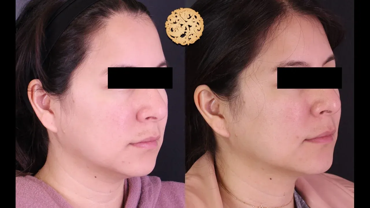 Under Eye Filler Before & After