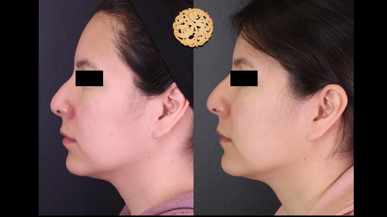Under Eye Filler Before & After