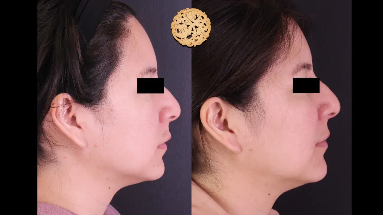 Under Eye Filler Before & After