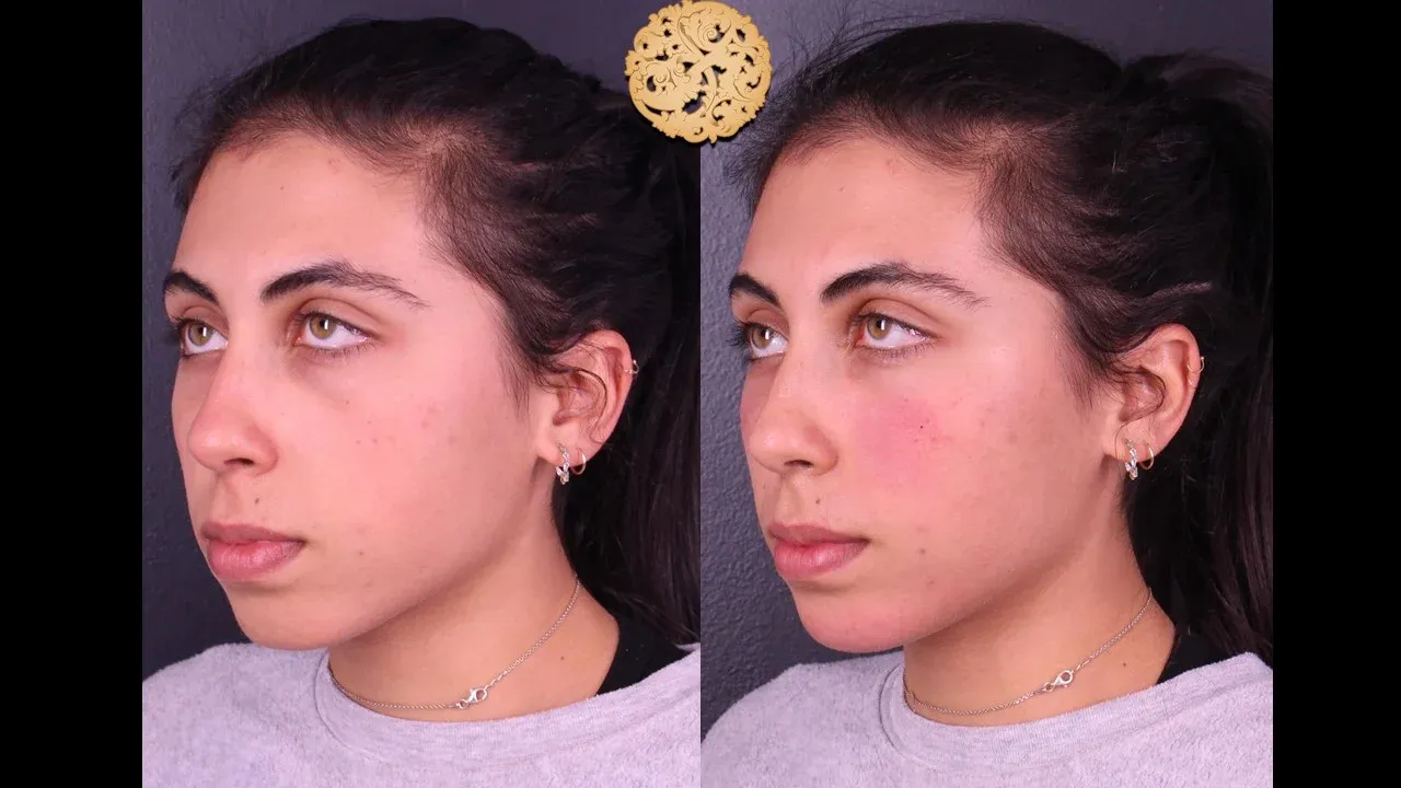 Under Eye Filler Before & After