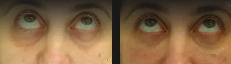 Under Eye Filler Before & After