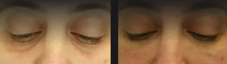 Under Eye Filler Before & After