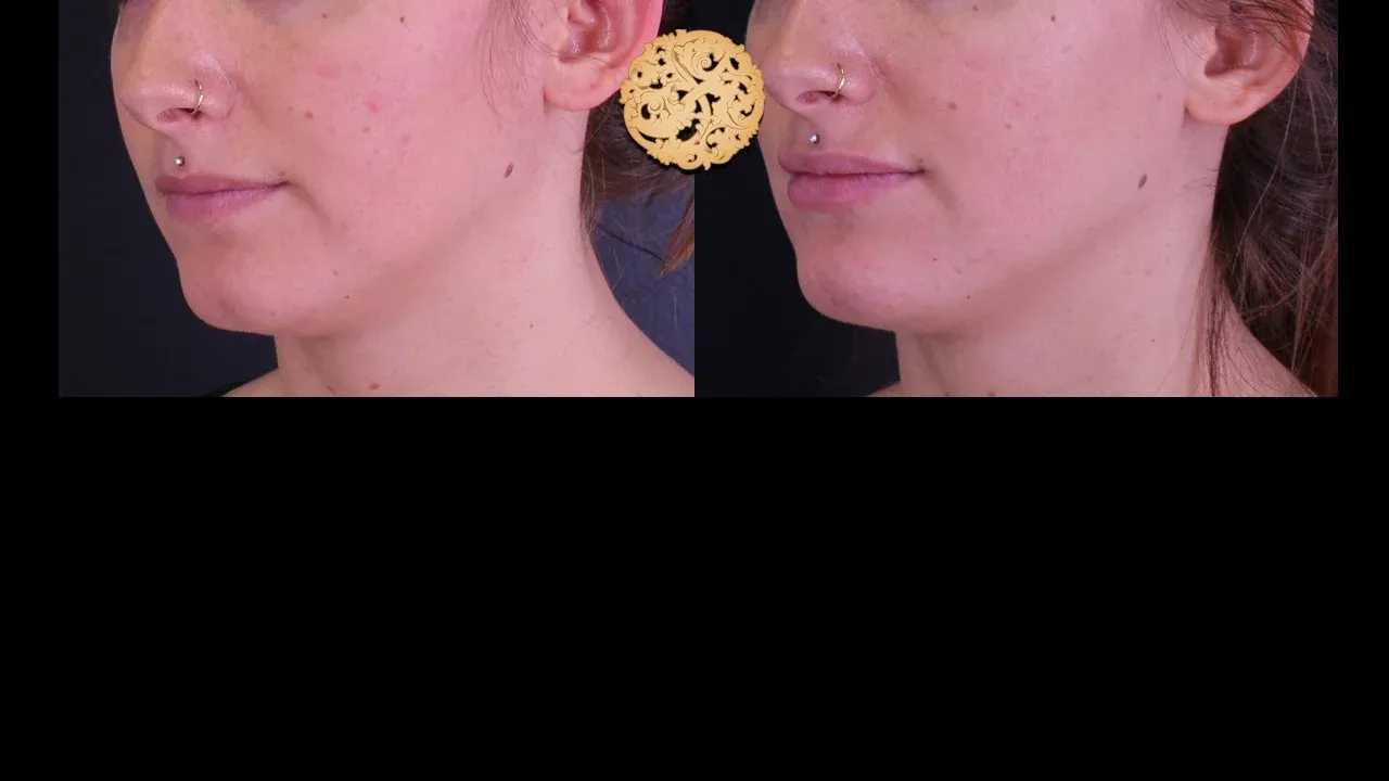 Under Eye Filler Before & After