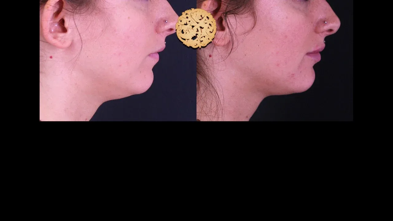 Under Eye Filler Before & After