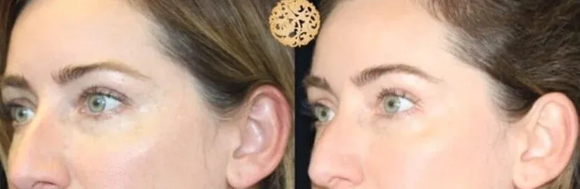 Under Eye Filler Before & After