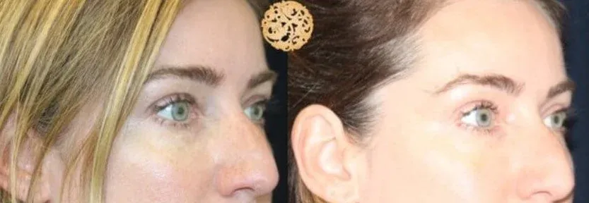 Under Eye Filler Before & After