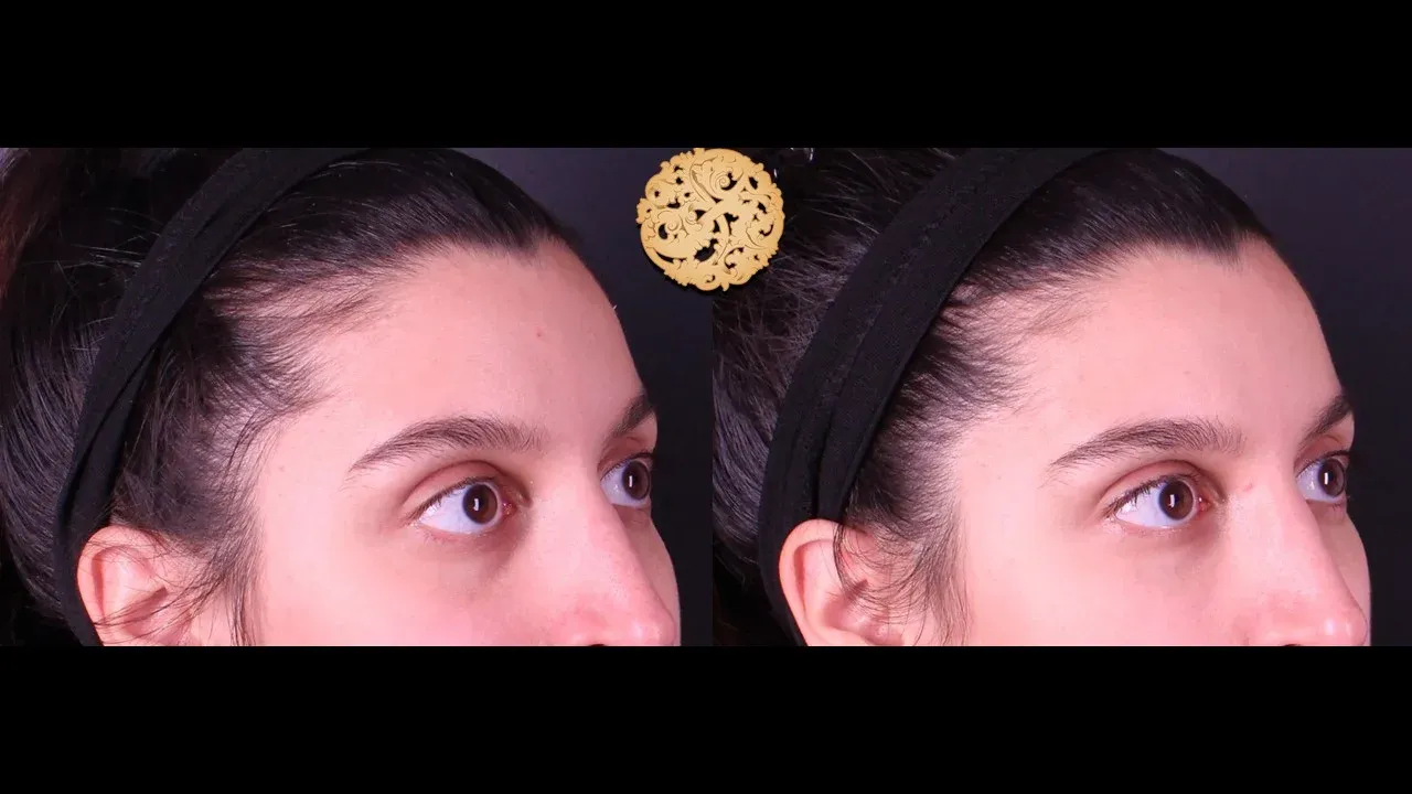 Under Eye Filler Before & After