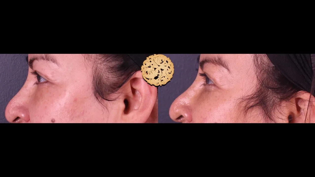 Under Eye Filler Before & After