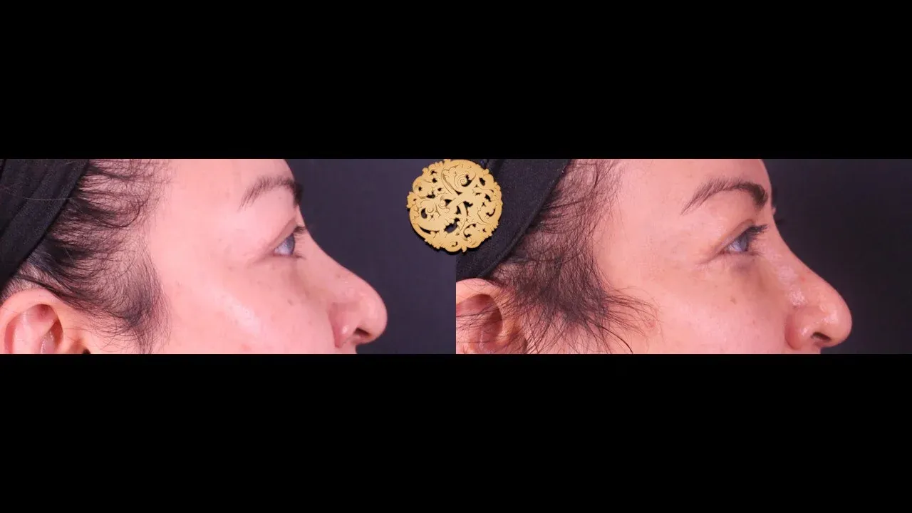 Under Eye Filler Before & After