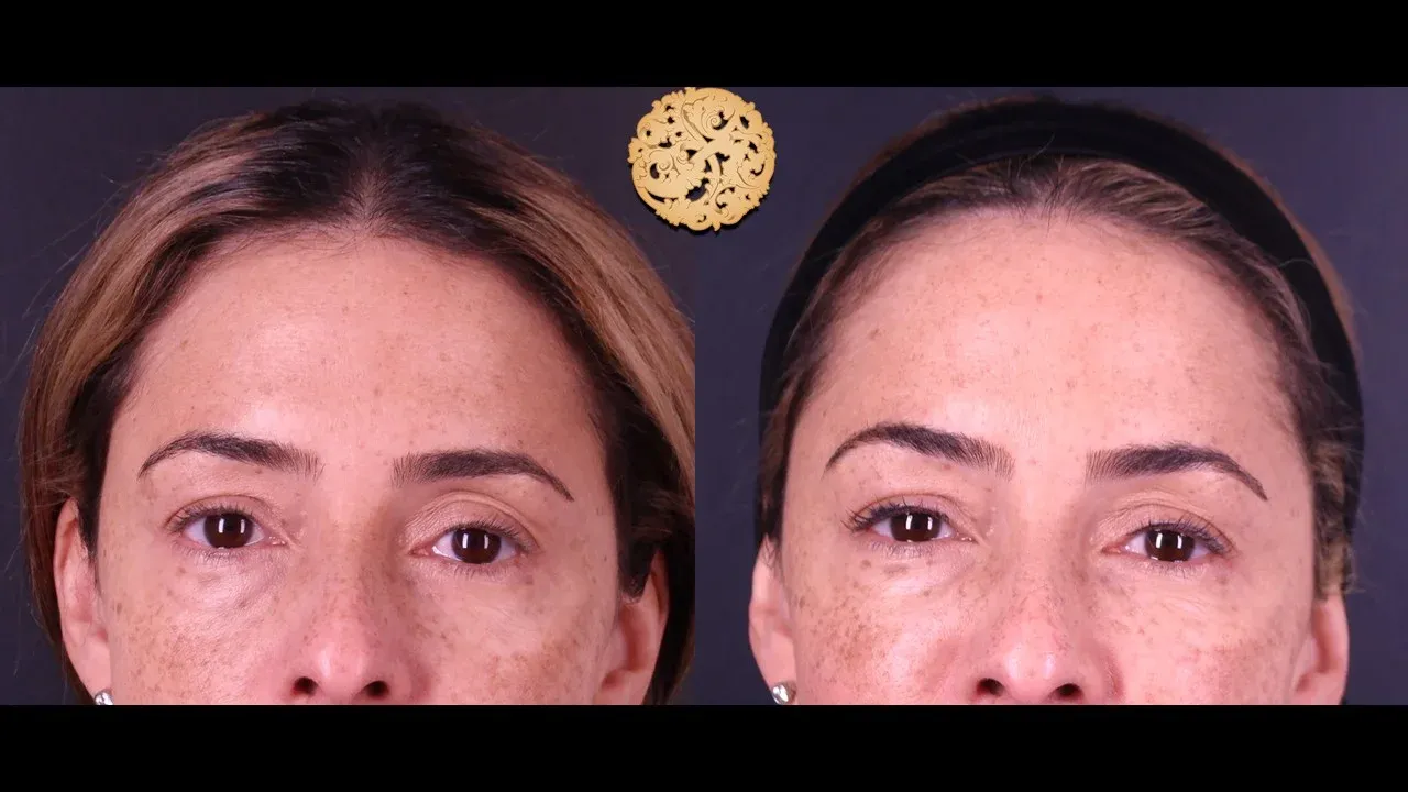 Under Eye Filler Before & After